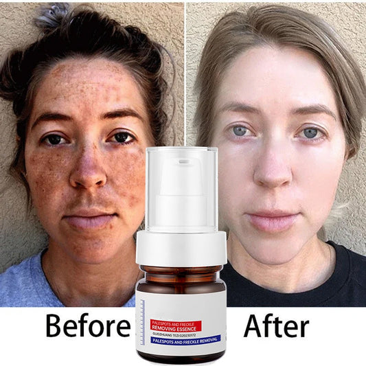 ⚡5-second brightening!Vitamin C Whitening Freckles ESSENCE